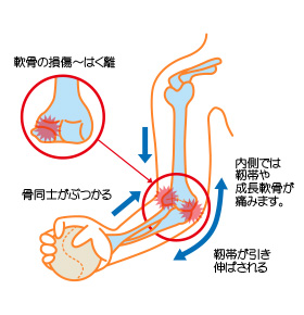 野球肘