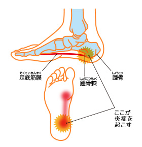 足底筋膜炎・足底腱膜炎