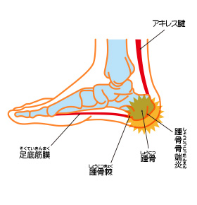 踵の痛み(踵骨骨端症・セーバー病)