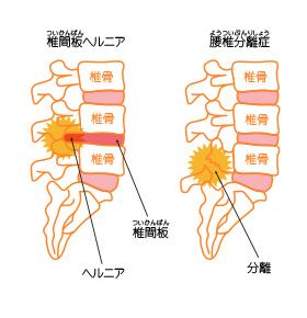 椎間板ヘルニア・腰椎分離症