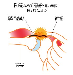 インピンジメント