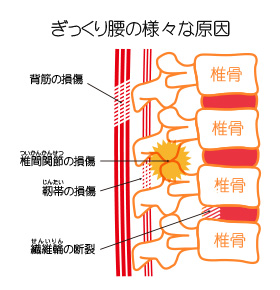 ぎっくり腰